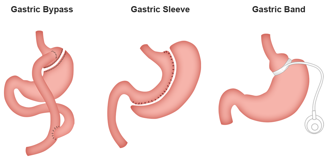 Gastric bypass and gastric sleeve in Poland. KCM Clinic more than medicine.